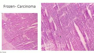 2021 Pathology Review: Gynecologic, Breast and Soft Tissue for the General Pathologist screenshot 4