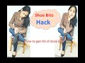 How To Get Rid Of a Shoe Bite Naturally at home|Home remedy of Shoe Bite|Genius Shoe Hacks|Pain Free