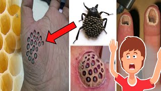 حشرة تسبب ثقوبا في الجلد عند ملامستها  , حقيقة أم أسطورة ؟ | فوبيا النخاريب Trypophobia