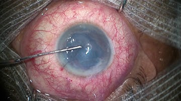 DMEK intraoperative OCT for low visualisation