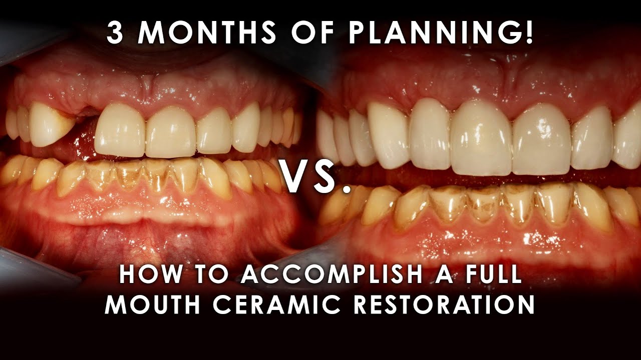 3 Months of Planning: How to Accomplish a Full Mouth Ceramic Restoration