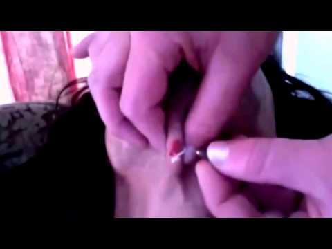Worlds Worst Chin Zits Part  Cysts, Comedones, Blackheads, Acne, Whiteheads YouTube