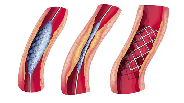 ¿Cuáles son los síntomas de la obstrucción de la arteria femoral?