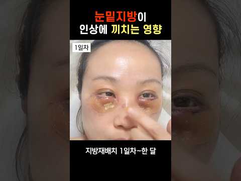   눈밑지방이 인상에 끼치는 영향 한달 후 눈밑지 눈밑지방재배치 눈밑지방재배치후기 지방재배치붓기 눈밑지방재배치회복과정 모즈클리닉