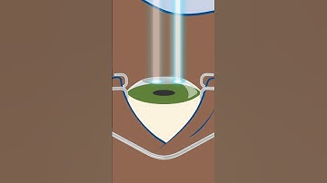 How does PRK surgery work to correct eyesight? #shorts
