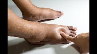 Nas pernas o parto inchaço grave após