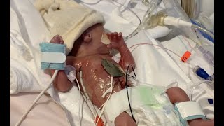 OUR NICU JOURNEY \/\/ 25 WEEKER MICRO-PREEMIE