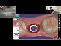 How to design screw retained implant based crown in Exocad (Medit i500, Cerec, 3shape, Carestream)