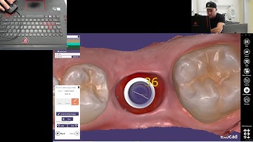 How to design screw retained implant based crown in Exocad (Medit i500, Cerec, 3shape, Carestream)