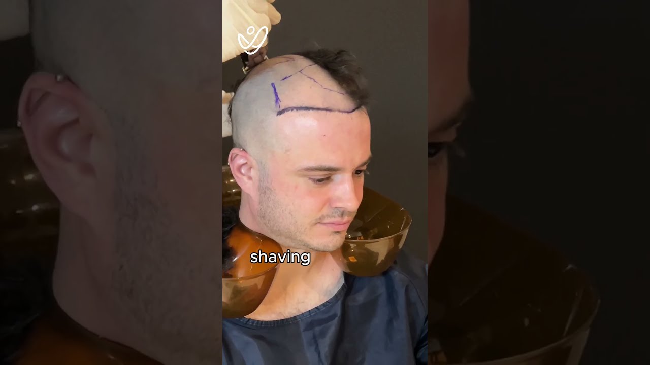 My Hair Transplant Journey From Start To 1 Month 