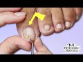 👣Pedicure Ingrown Fungal Toenail👣