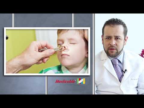 Vídeo: Curvatura Del Tabique Nasal En Niños: Síntomas Y Tratamiento