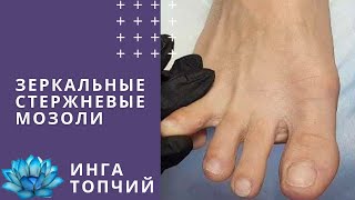 Стержневая мозоль между пальцами. Как лечить?