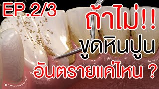 ถ้าไม่ขูดหินปูนอันตรายแค่ไหน ? | EP.2/3 | โชคช่วย กับหมอโชค