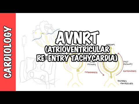 AVRNT (atrioventricular re-entry tachycardia) - causes, pathophysiology, treatment