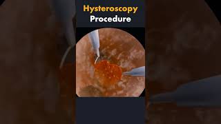 How Hysteroscopy Removes Fibroids and Polyps | Herba Clinic | Anjela Jeganathan #holistichealth