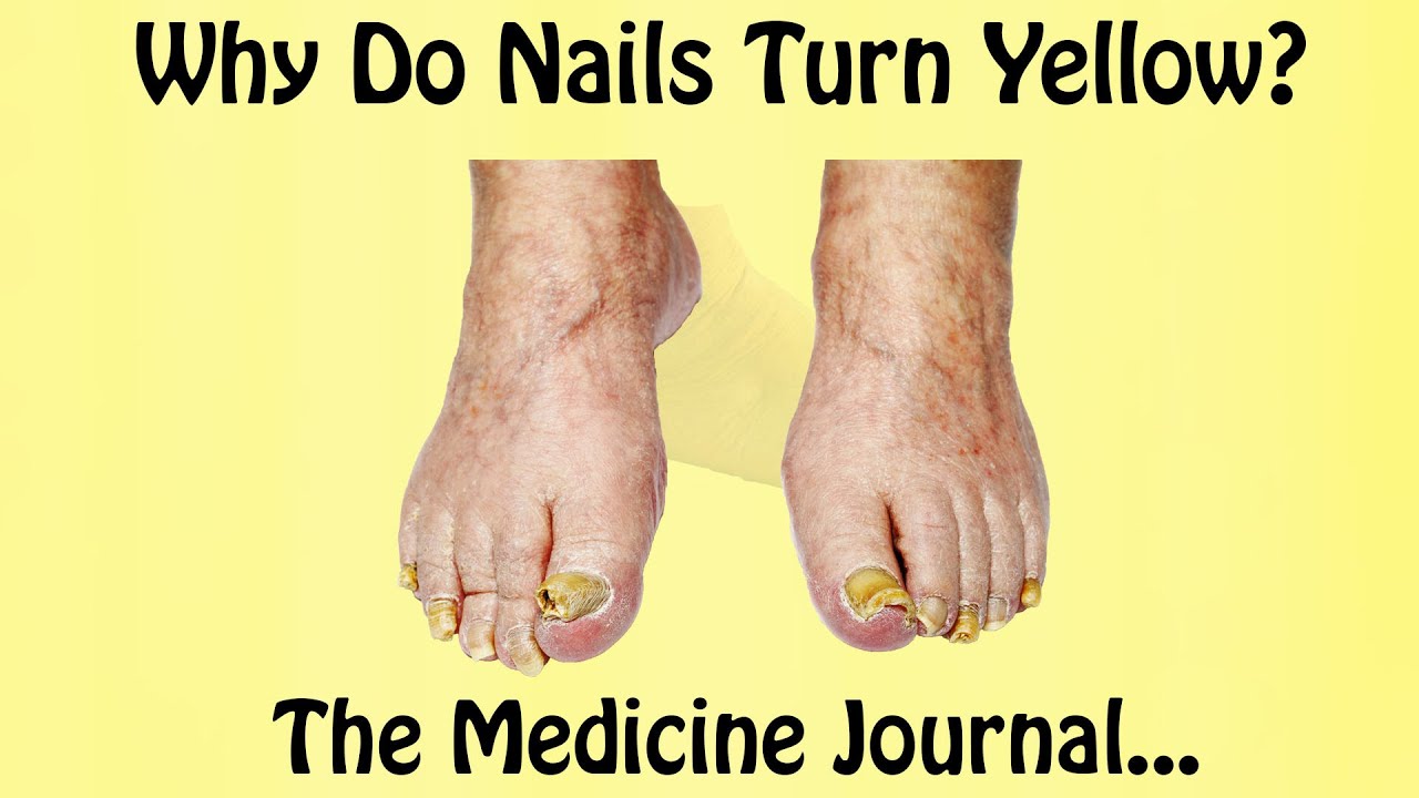 What can you do about yellow nails? | Ohio State Medical Center