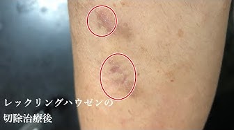 神経線維腫症 Youtube
