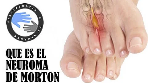 ¿Cómo es el dedo del pie de Morton?