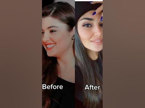 Hande Erçel Before | After #handeerçel #before #after #beautiful # ...