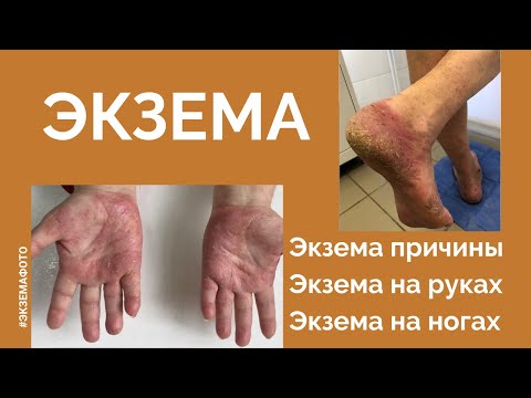 Экзема. Экзема причины. Экзема на руках. Экзема на ногах. Экзема фото.