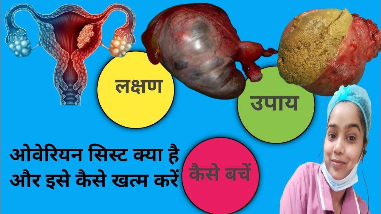 Ovarian cyst👹 बच्चेदानी में गांठ कैसे बनती है bachhedani me ganth