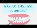 PERIODONTAL DISEASE: CAN IT BE REVERSED? 🦷🔍✨