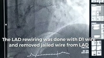 LAD-Diagonal bifurcation stenting with cluotte technique.