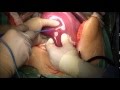 Hepatic Parenchyma Transection Hepatic Parenchyma Transection