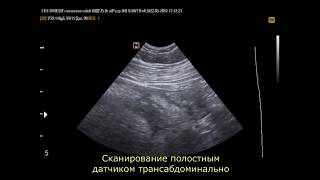 Аппендикулярный инфильтрат (22 -5 -18) Аппендикулярный инфильтрат (22 -5 -18)