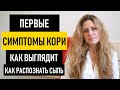 Признаки и симптомы кори у взрослых и детей. Как выглядит корь на теле и как распознать сыпь