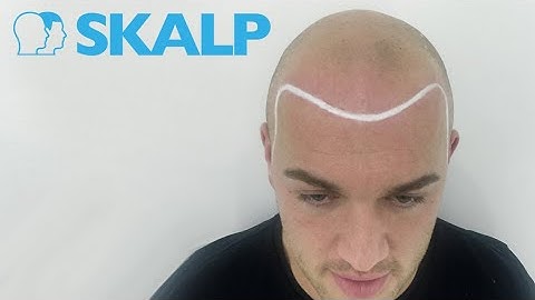Scalp Micropigmentation before and after results by Skalp®