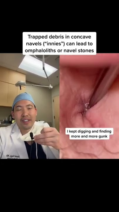#shorts Dermatologist Reacts to Dirty Belly Button Extraction