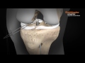 ULTRABUTTON* Device and BIOSURE* REGENESORB Screw for ACL Reconstruction with a Hamstring Graft