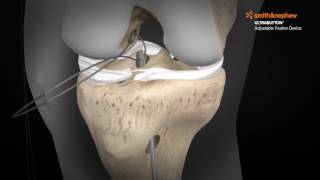 ULTRABUTTON* Device and BIOSURE* REGENESORB Screw for ACL Reconstruction with a Hamstring Graft screenshot 4