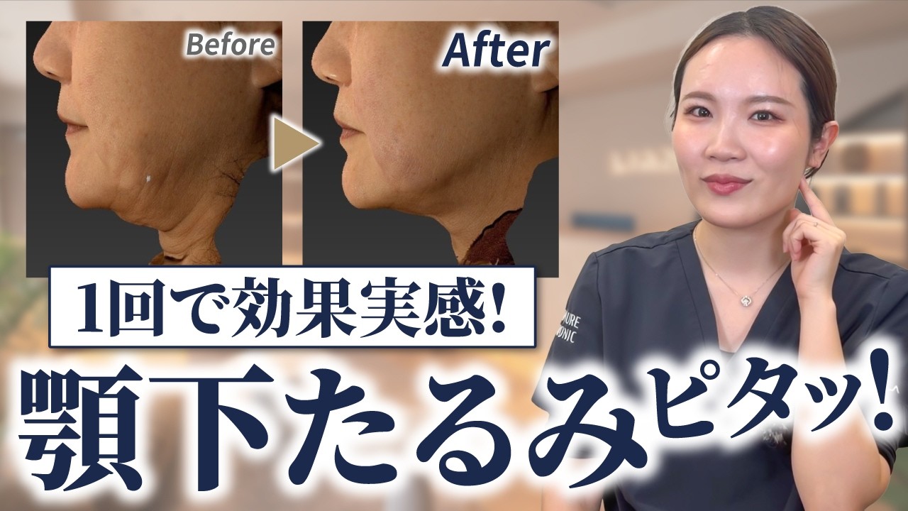 顎下のたるみ・二重あごの解消方法を解説します。【切らずにここまで！】