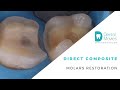 Direct composite molars restoration