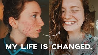 [Outdated Video: Watch the Updated Version on My Channel!!] The Best Way To Heal Your Acne