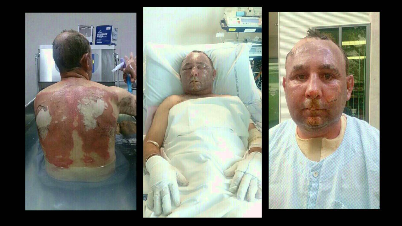 Ravenshoe: The worst burns disaster in Queensland's history