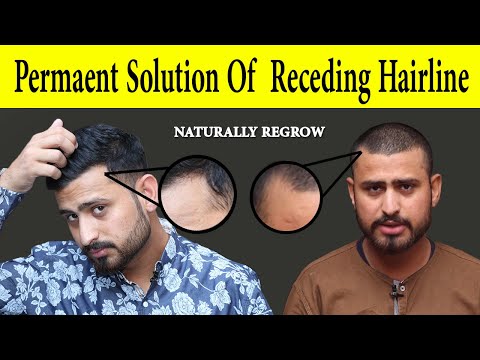 permanent-solution-of-receding-hairline-haircuts-naturally-at-home-|-receding-hairline-regrowth