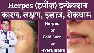 Herpes Infection Of Skin | हर्पीज़ के कारण, लक्षण, इलाज | Herpes Symptoms, Causes, Treatment | Hindi