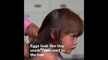 How To Find Head Lice Early 
