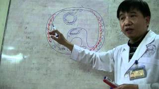 20120509_Tràn khí dưới da sau mổ 3 (Postoperative subcutaneous emphysema)
