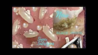 Make your day Relax with Relaxing LNS / blackheads removal/ blackheads animation blackheadsremoval