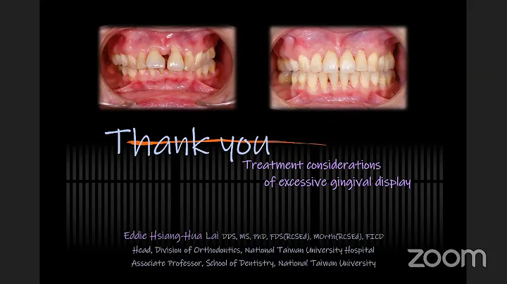 Treatment Considerations of Exessive Gingival Display  - Dr. Eddie Hsiang Hua Lai