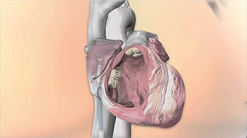 Micra Patient Animation