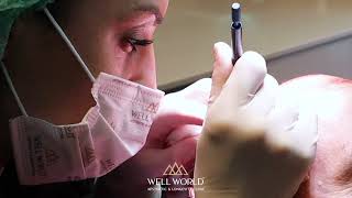 Hair Transplant Stages Well World Aesthetic Longevity Clinic