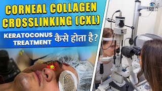 Corneal Collagen Crosslinking (CXL) Treatment कैसे होता है | Keratoconus Treatment Procedure
