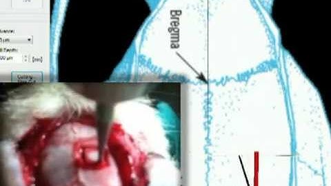 Neurostar - Drill Robot - Automated Stereotaxic Drilling - Surgery