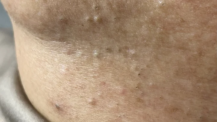 Relaxing Acne Treatment #72(Linh My Dang)